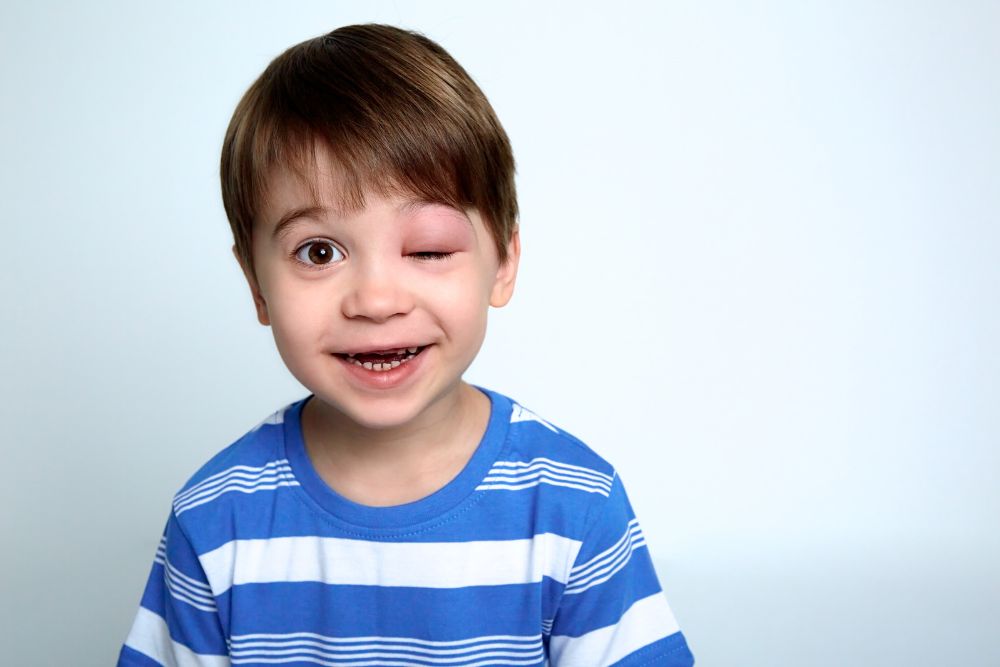 Angioedema Hereditário em Blumenau